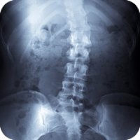 scoliosis_chiropractic